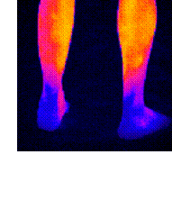 Lower leg thermogram